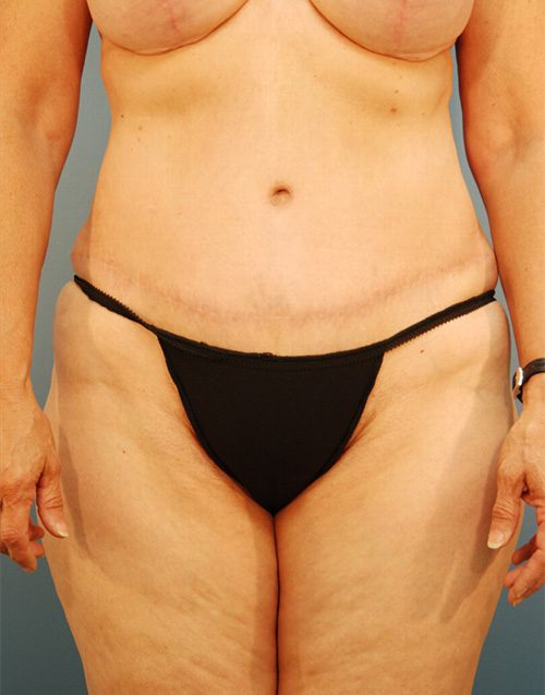 Case--5602 | After Abdominoplasty 