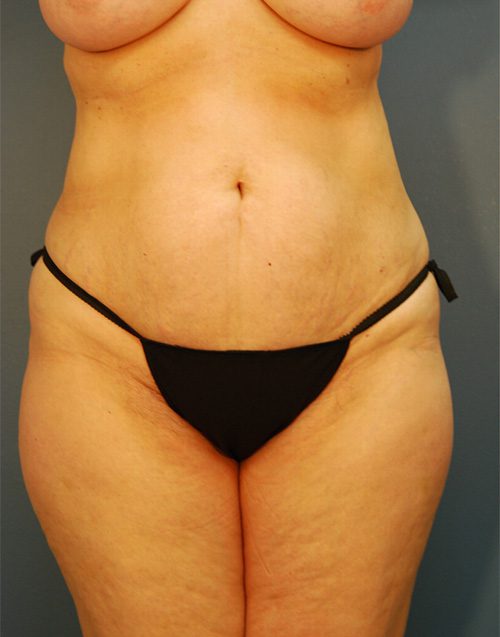 Case--5602 | Before Abdominoplasty 