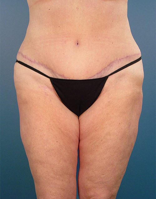 Case--2414 | After Abdominoplasty 