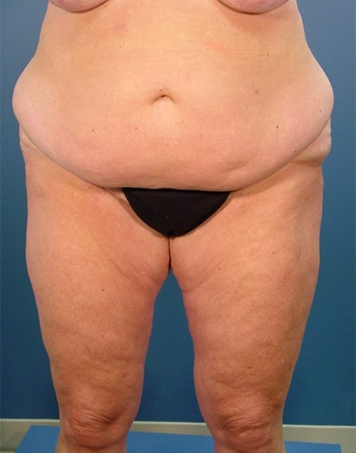 Case--2414 | Before Abdominoplasty 