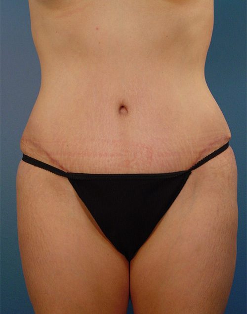 Abdominoplasty Patient After