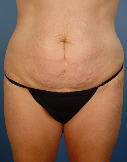 Abdominoplasty Patient Before