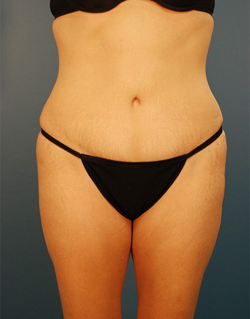 Case--5295 | After Abdominoplasty 
