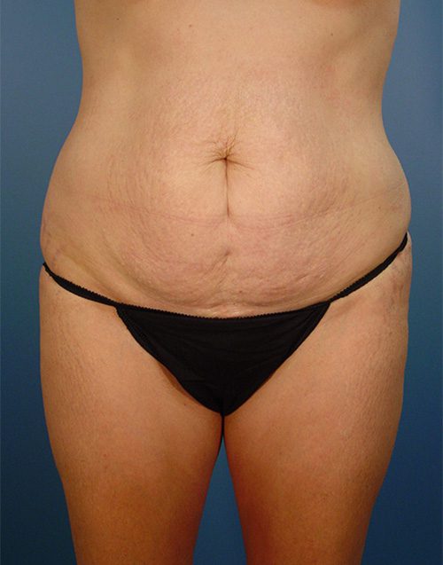 Case--5295 | Before Abdominoplasty 