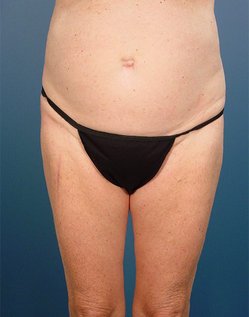 Case--6857 | Before Abdominoplasty 
