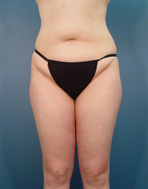 Case--9160 | Before Abdominoplasty 