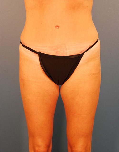 Case--4935 | After Abdominoplasty 