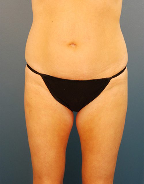 Case--4935 | Before Abdominoplasty 