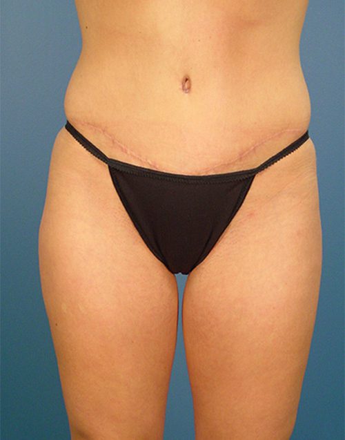 Case--9605 | After Abdominoplasty 