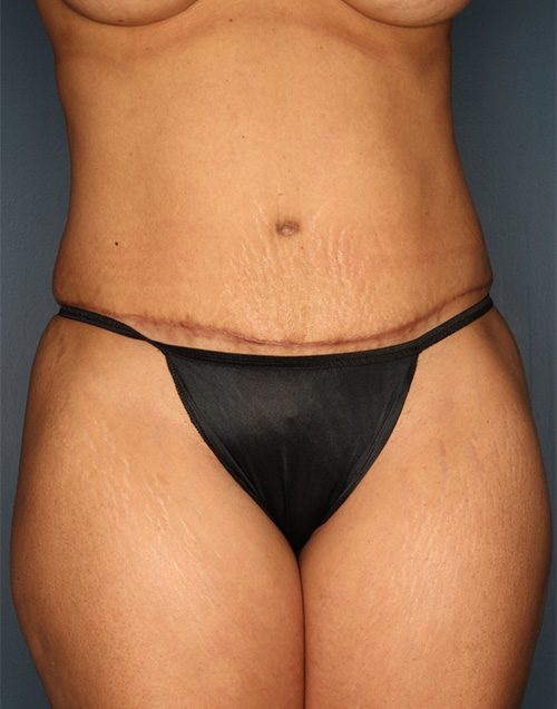 Case--5380 | After Abdominoplasty 
