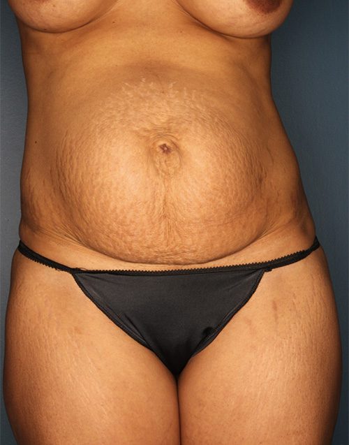 Case--5380 | Before Abdominoplasty 