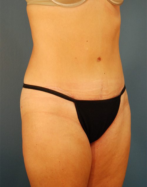Case--4818 | After Abdominoplasty 