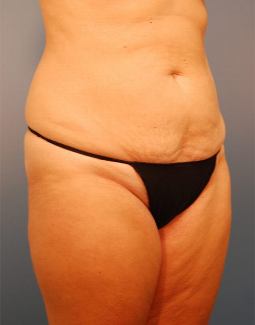 Case--4818 | Before Abdominoplasty 