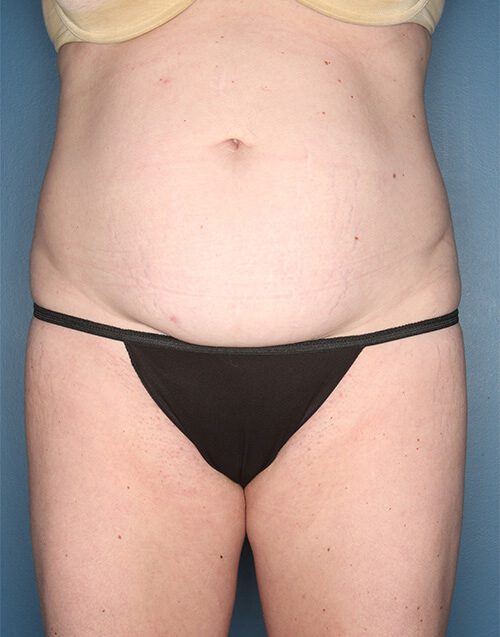 Case--2082 | Before Abdominoplasty 