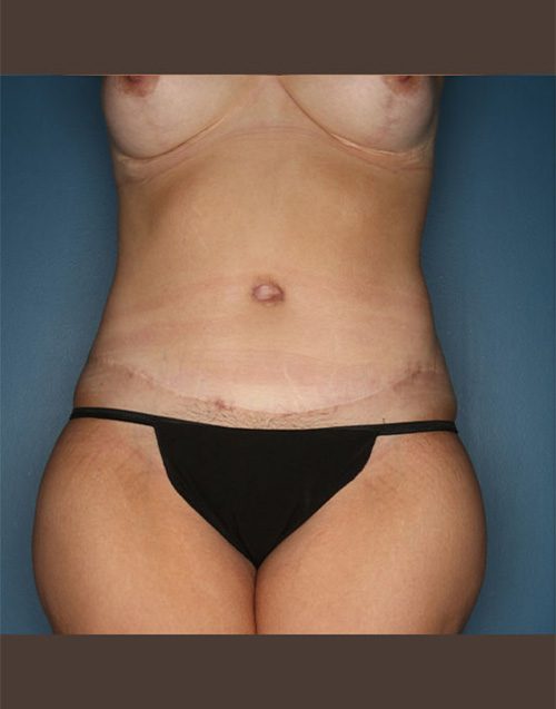Case--1269 | After Abdominoplasty 