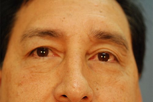 Upper eyelid Lift Before
